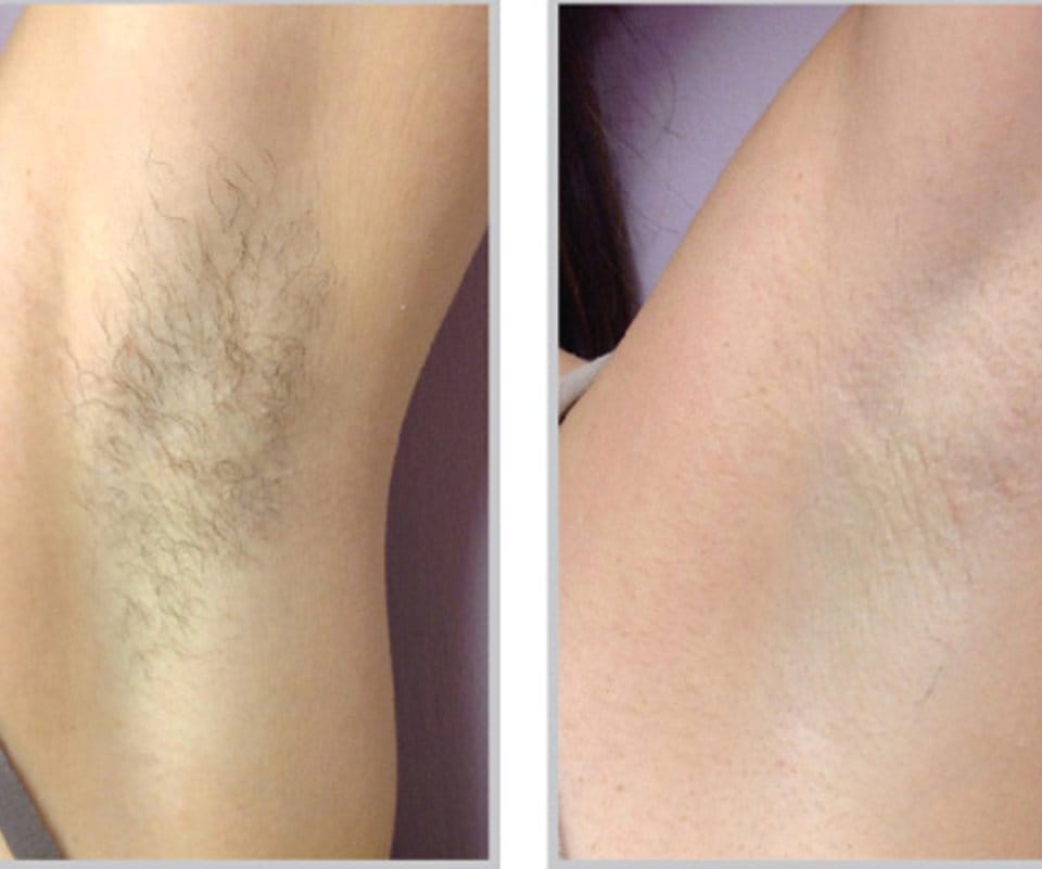 Laser Hair Removal Near Me | Permanent Laser Hair Removal Bellevue