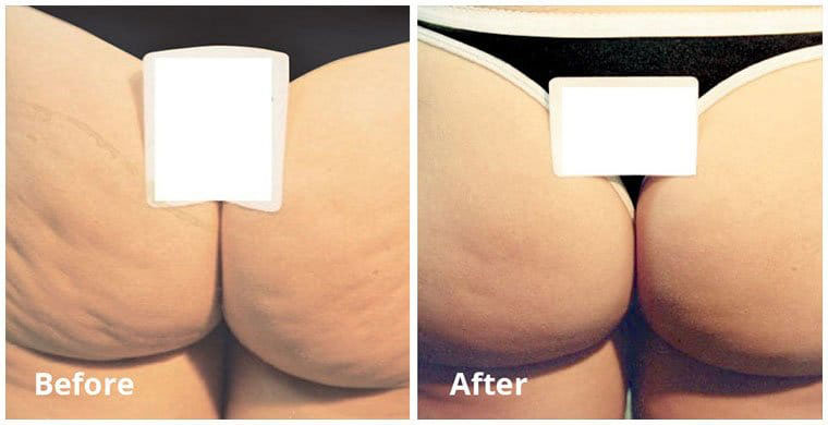 Cellulite Results, Before and After